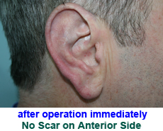 plastic-surgery-prominent-ear 